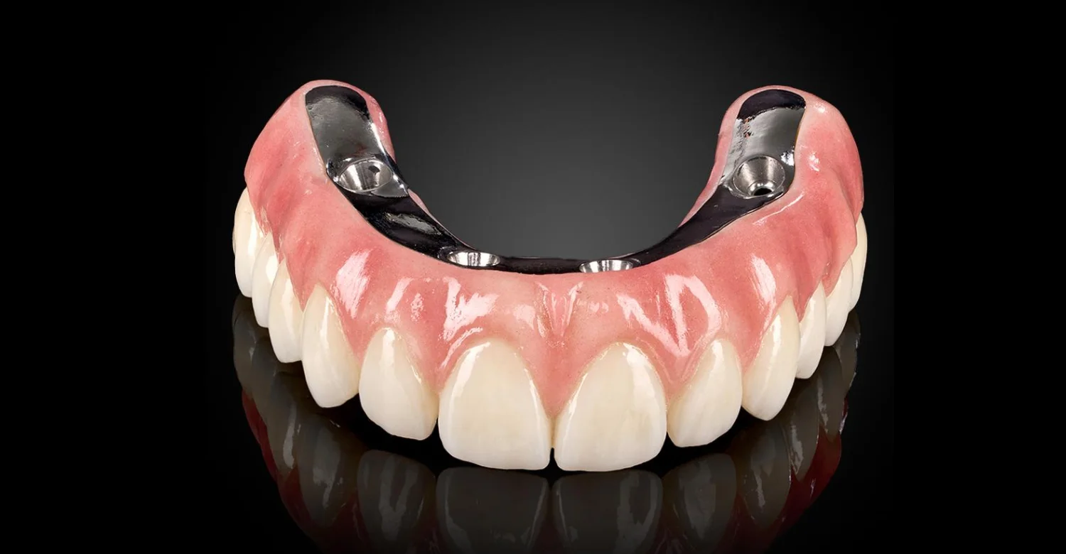 Hybrid Dental Implant Rehabilitation 2